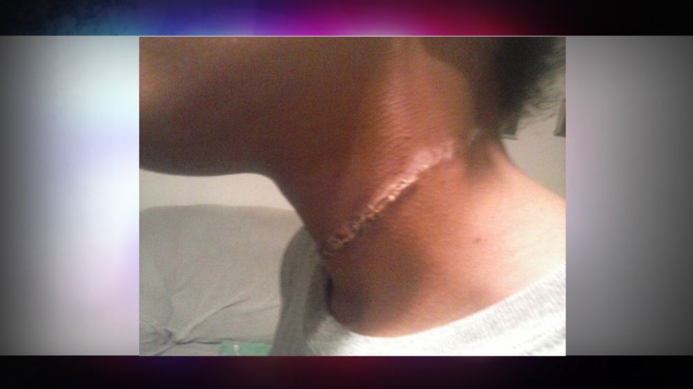 Parents of black girl, 12, with rope burn sue Texas school