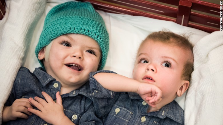 Once-conjoined twins going to rehab 9 weeks after separation