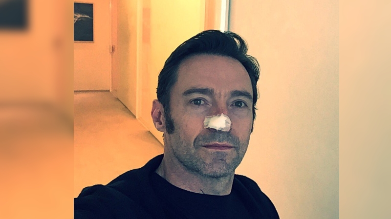 Hugh Jackman shows off bandaged nose after cancer treatment