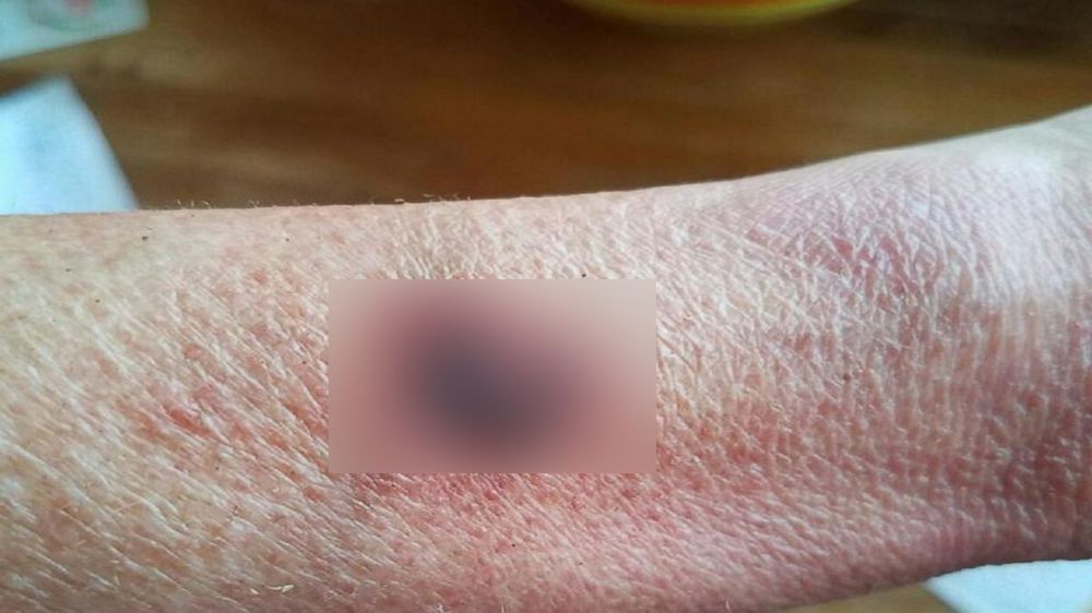 Report: Wisconsin woman suffers second-degree burns after Fitbit explodes