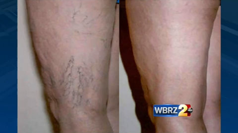 vericose veins treatment
