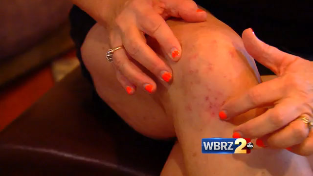 Residents getting skin irritations from flood water and cleaning products